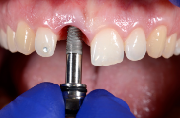 Dental implant