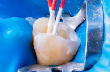 Root canal treatment