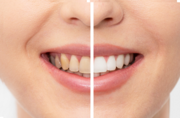 Before and after teeth whitening comparison