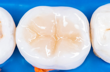 Tooth-coloured filling