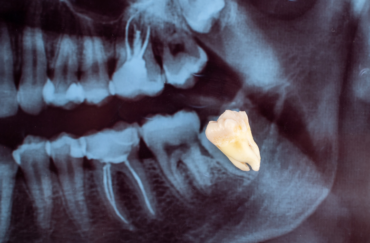 An x-ray of a human teeth emphasizing on wisdom tooth
